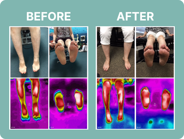 A comparative thermal imaging chart showing the results of a 12-week treatment with 'poor circulation' on the left and 'good circulation' on the right, used to indicate improved blood flow after treatment.
