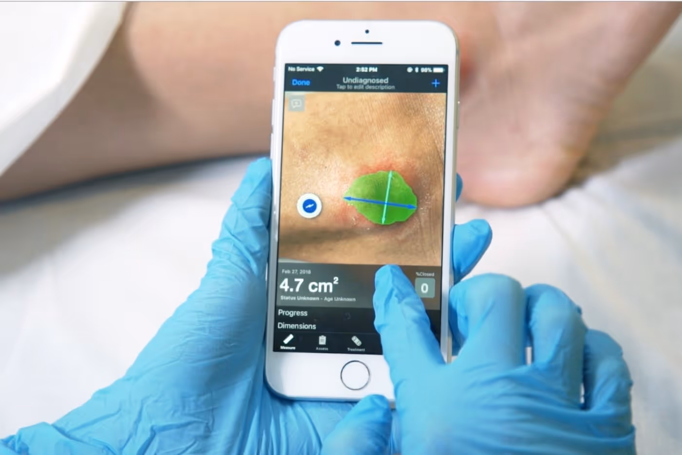 Clinician wearing blue gloves uses Swift Medical app on a smartphone to measure and track wound size.