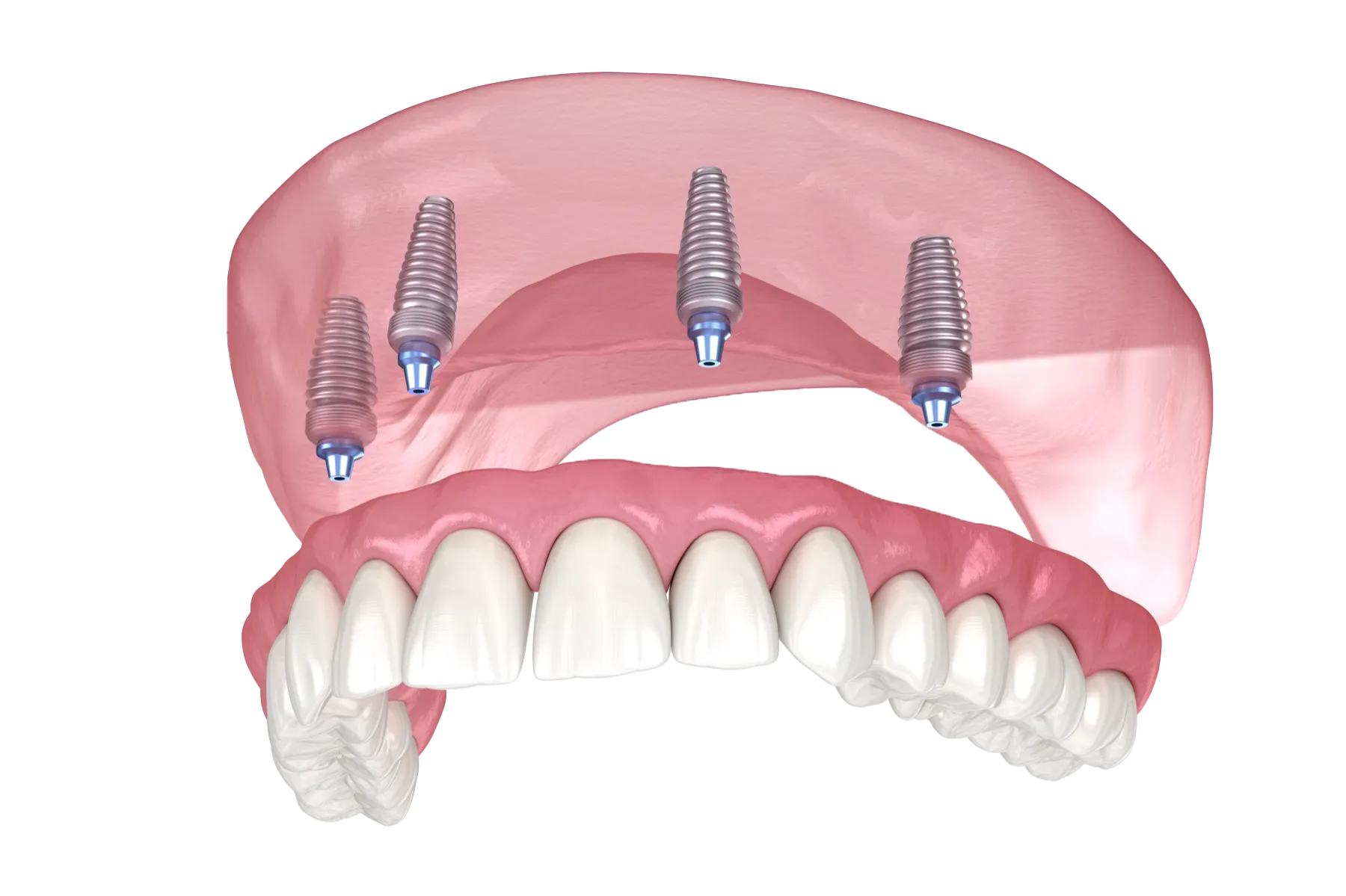 Dental implants secured in jawbone, showing multiple titanium tooth roots