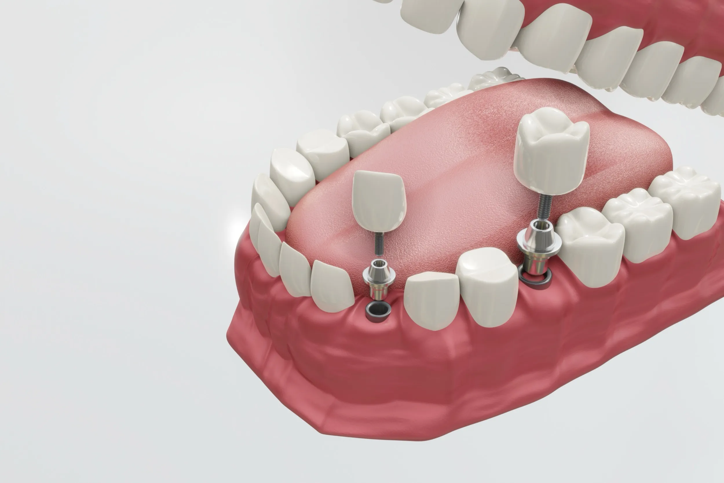 Dental implant procedure showing tooth replacement in jaw model