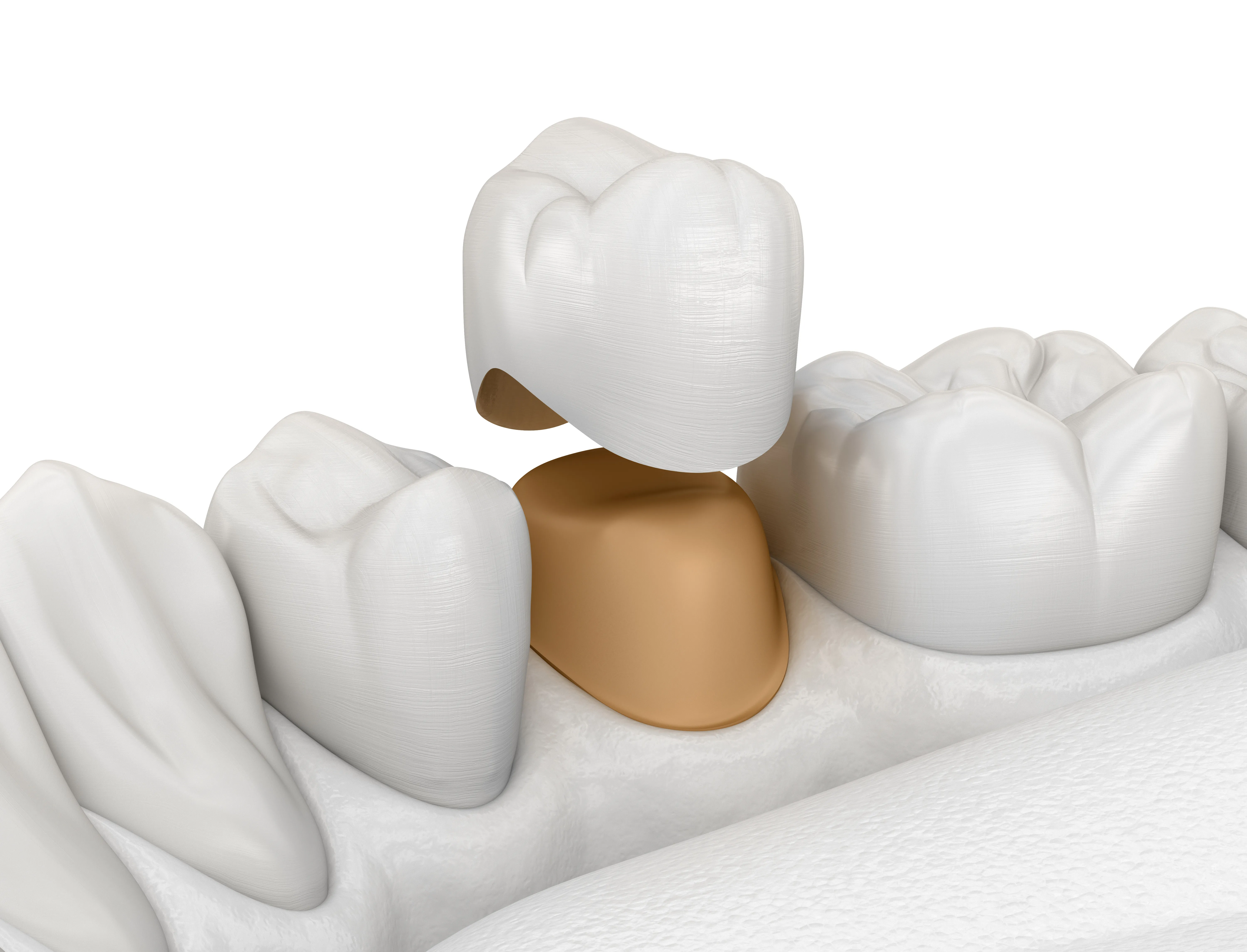 Dental crown placed between white teeth on textured surface