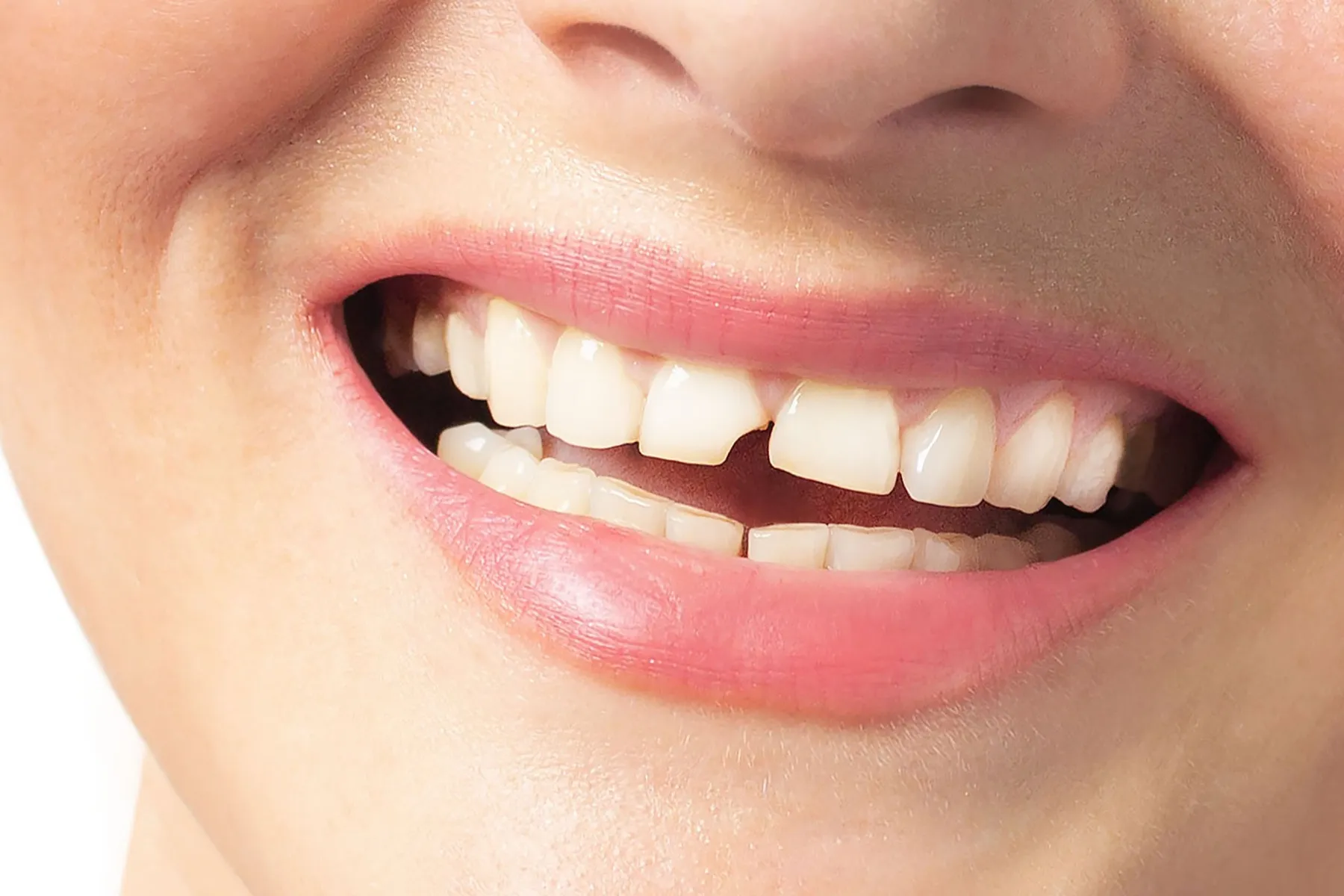 Close-up of a bright, healthy smile with white teeth