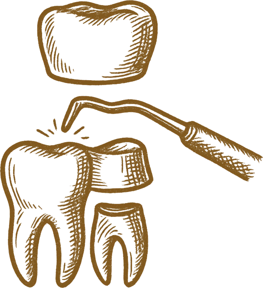 Dental illustration showing tooth with drill and dental crown