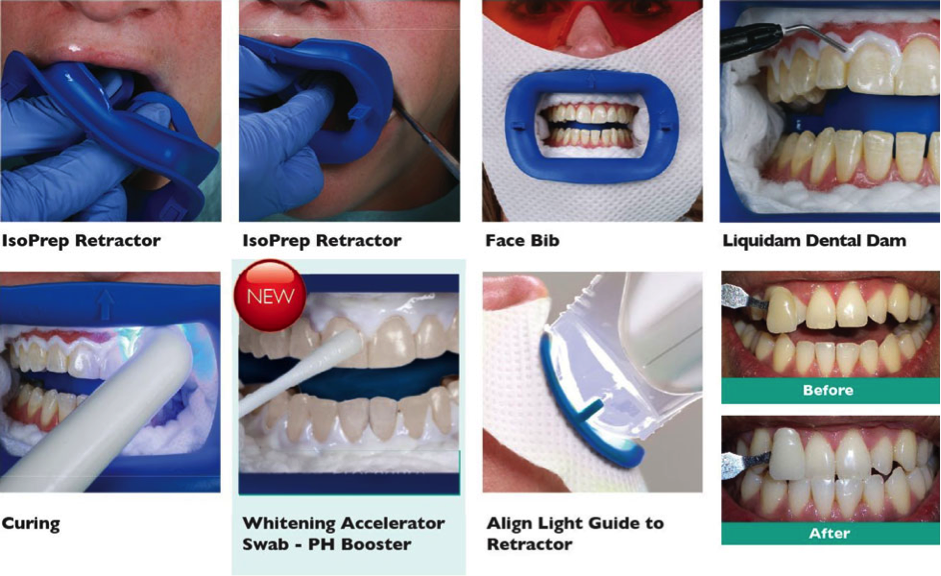 professional teeth whitening