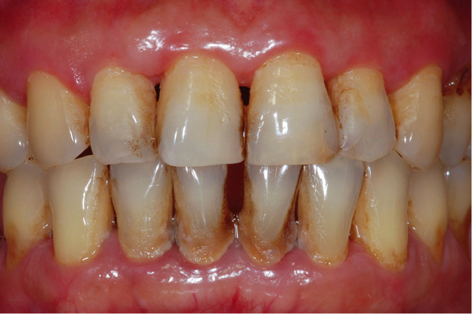 smoker teeth discoloration