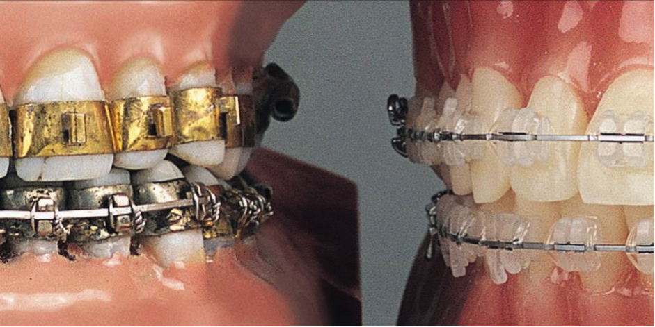 the old and new dental braces