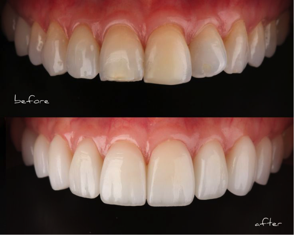 veneer before after