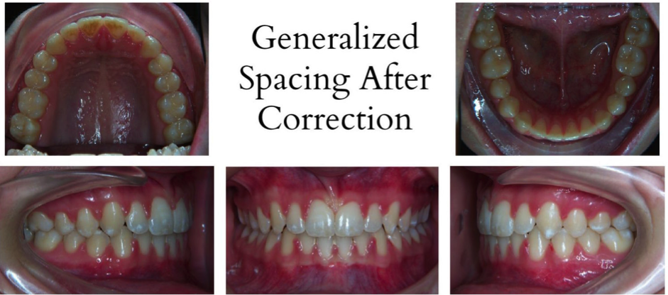 crooked teeth corrected by braces