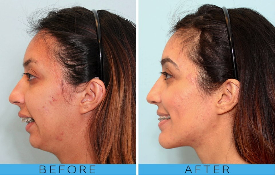 before and after braces teeth