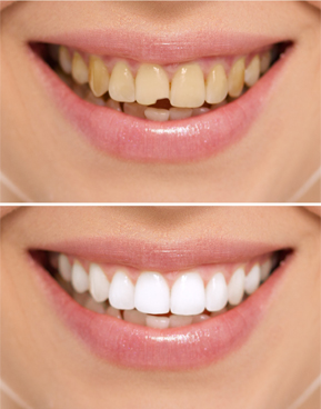 discoloured or disfigured teeth
