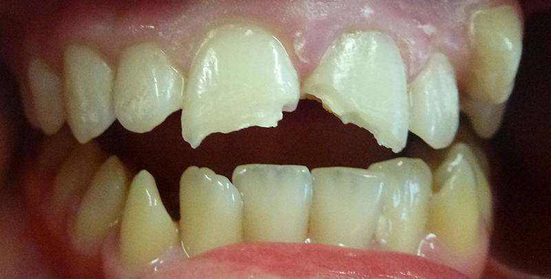 cracked upper front tooth