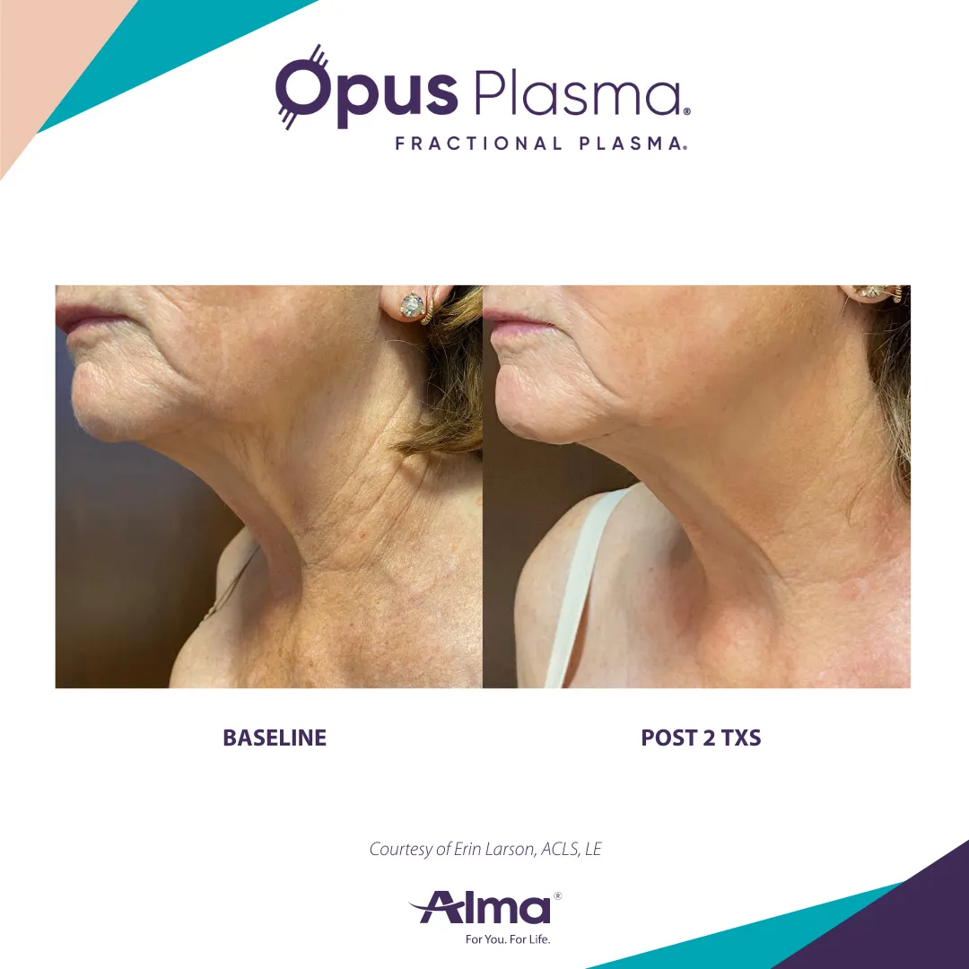 skin tightening