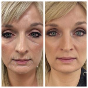 juvederm