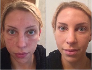 collagen loss