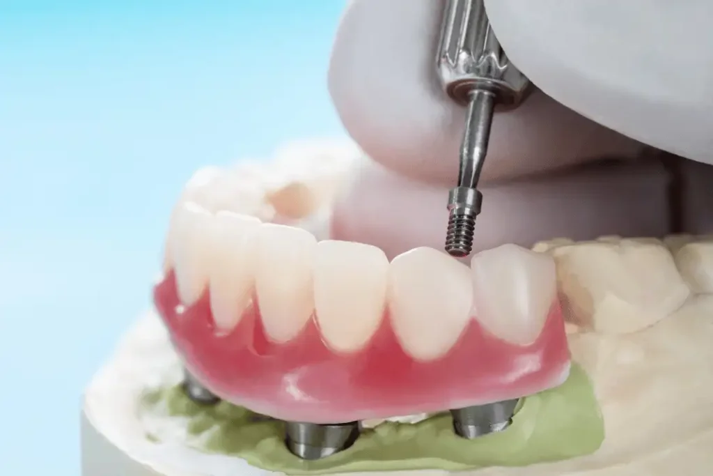 Mini Dental Implants