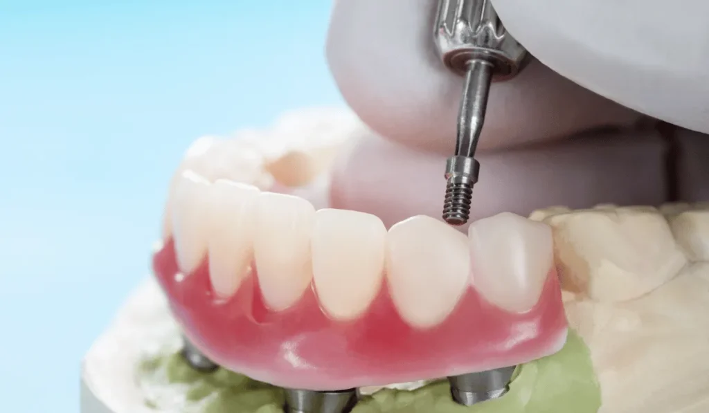 Dental Implants