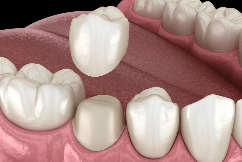 Same Day Crowns