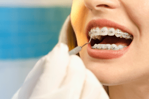 Clear Braces vs Metal Braces