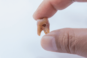 Tooth Decay