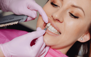 Do veneers last a long time
