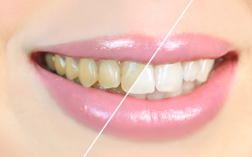 Teeth Whitening