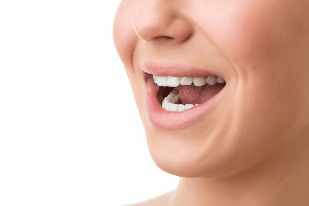 Canker Sore