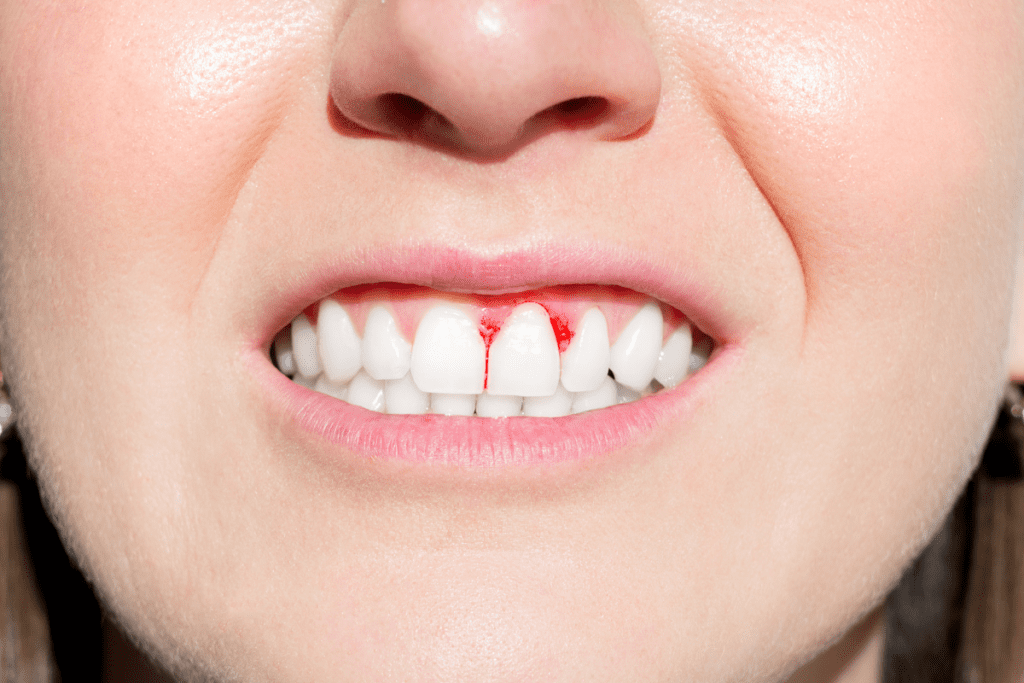 Prevent Gum Disease