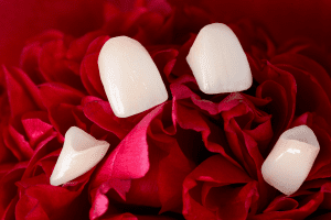 Dental Veneers
