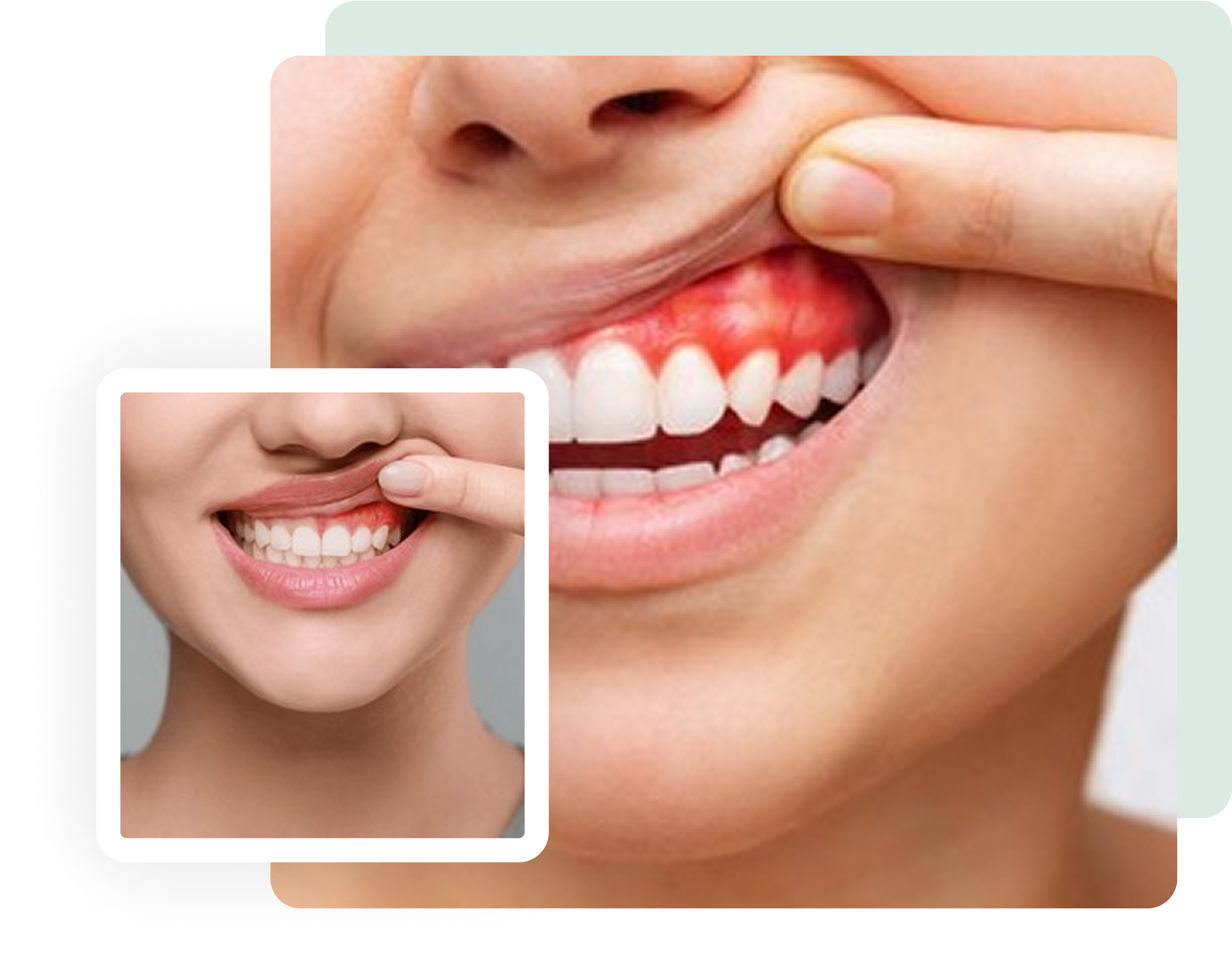 Close-up of a person's mouth showing receding gums.