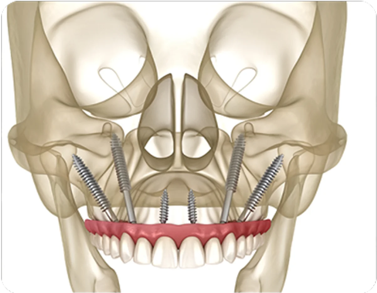 Zygomatic & Pterygoid Implants