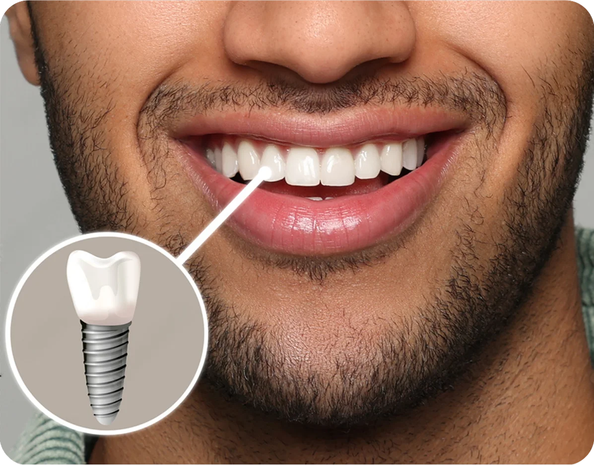 Single Tooth Implants