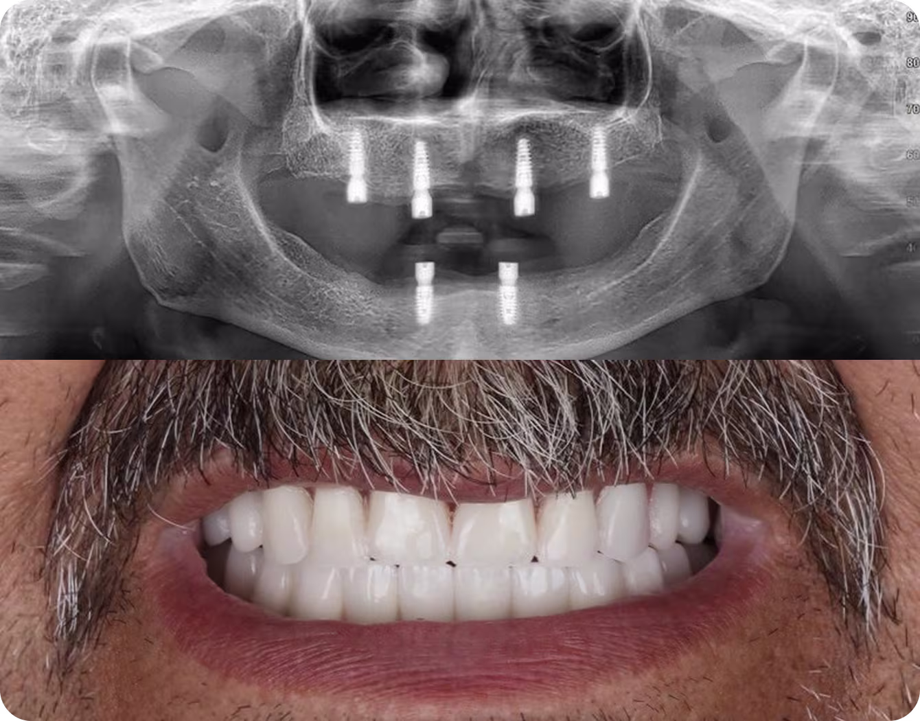 Panoramic X-ray of dental implants and a man smiling with full-arch dental prostheses. 