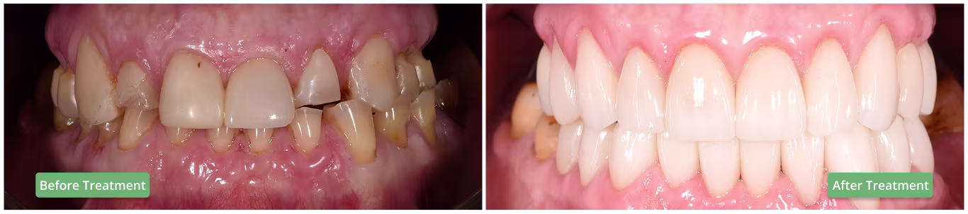Dental implants before and after treatment, showing improved aesthetics. 