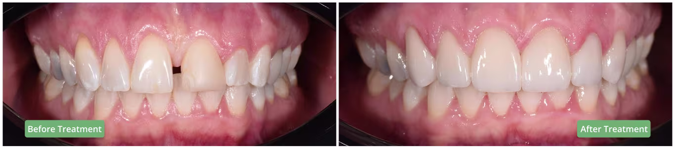 Dental composite bonding before and after treatment to close a gap between front teeth. 