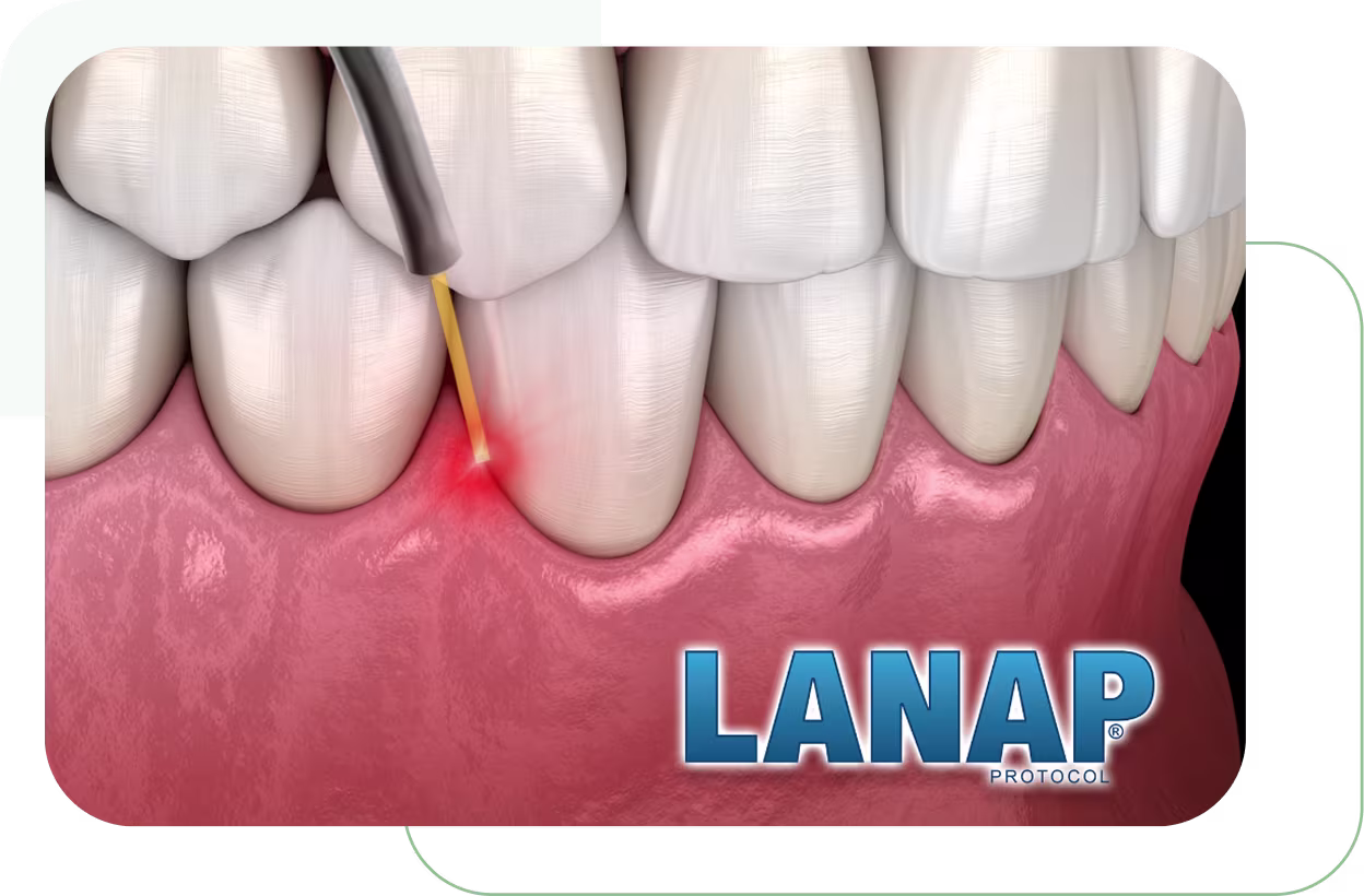 An animated illustration depicts a laser treating advanced gum disease around a tooth, highlighting the LANAP procedure relevant to dental care and potentially related to the health of potential implant sites. 