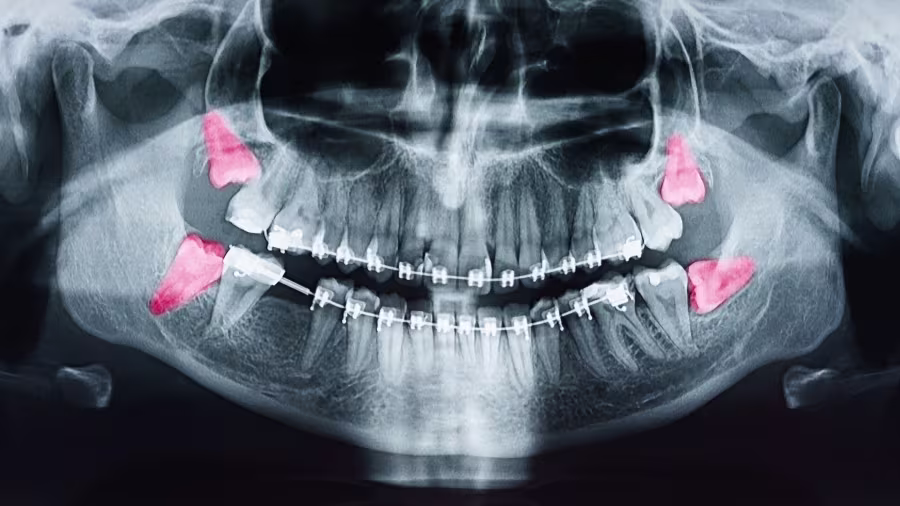Dental X-ray scan showing teeth, braces, and highlighted areas potentially indicating wisdom teeth or areas for dental implants.