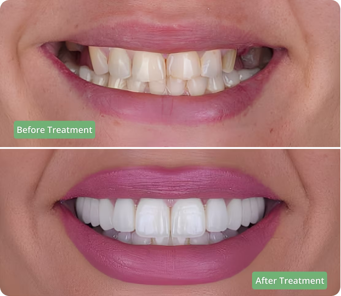 A before and after comparison of a smile, showcasing the results of dental implant treatment. 