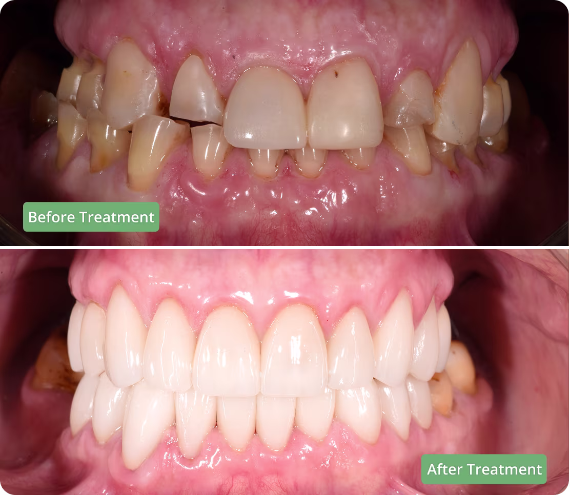 Dental implants before and after treatment, showing improved aesthetics. 