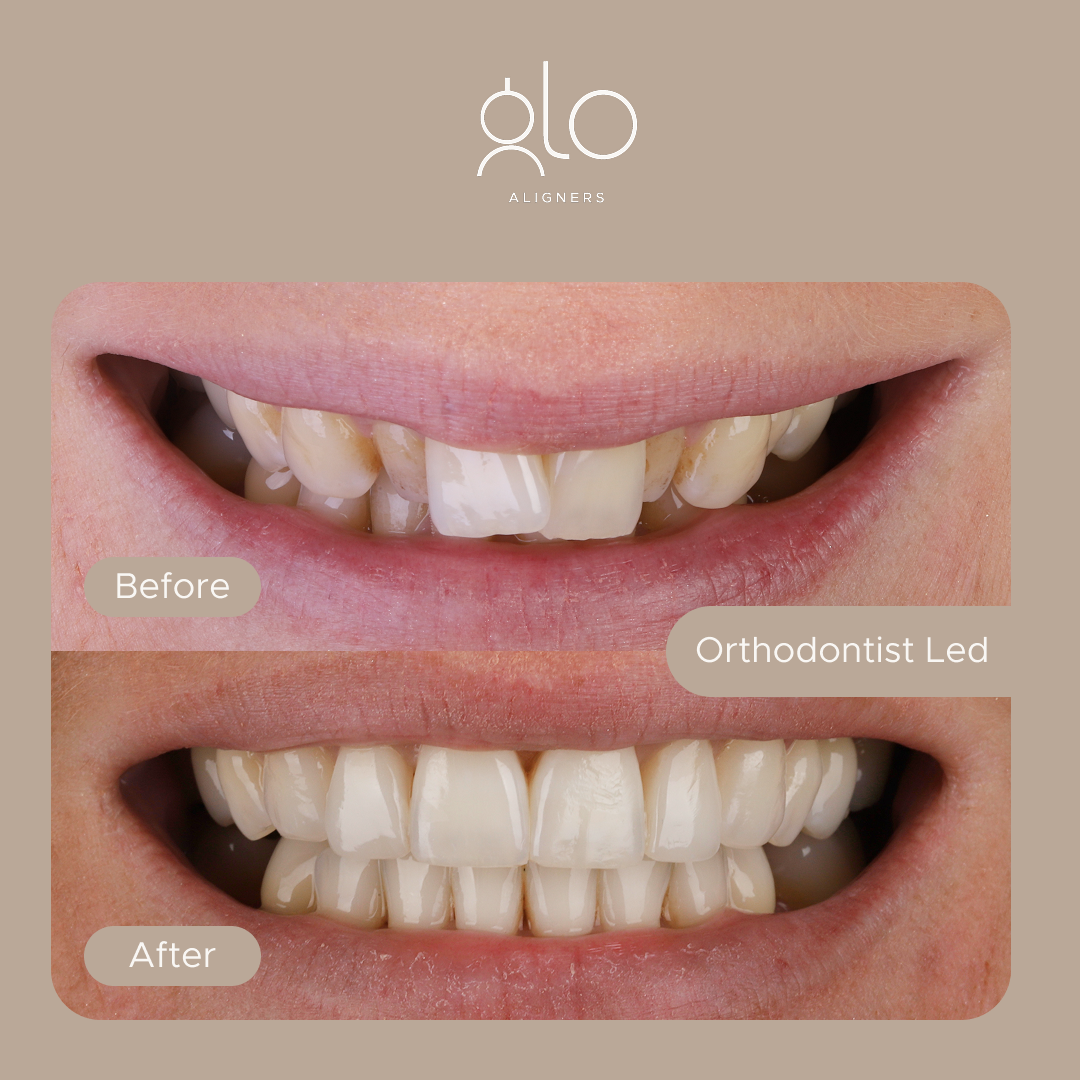 Glo Aligners before-and-after example 1