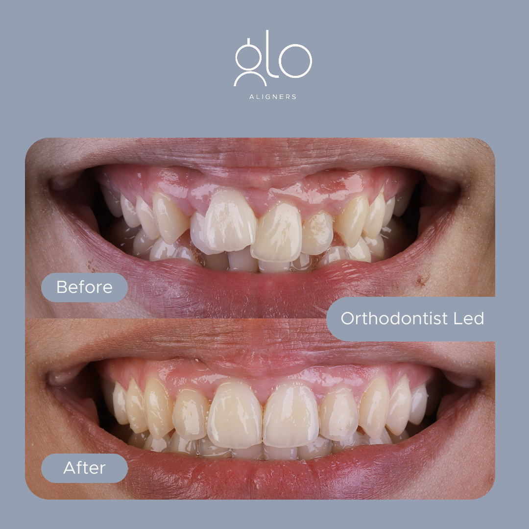 Glo Aligners before-and-after example 3