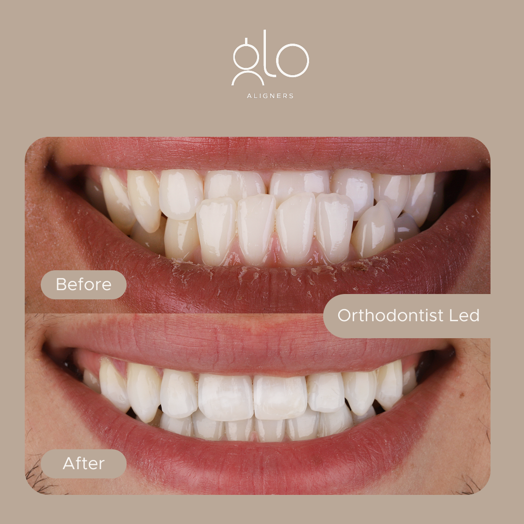 Glo Aligners before-and-after example 4