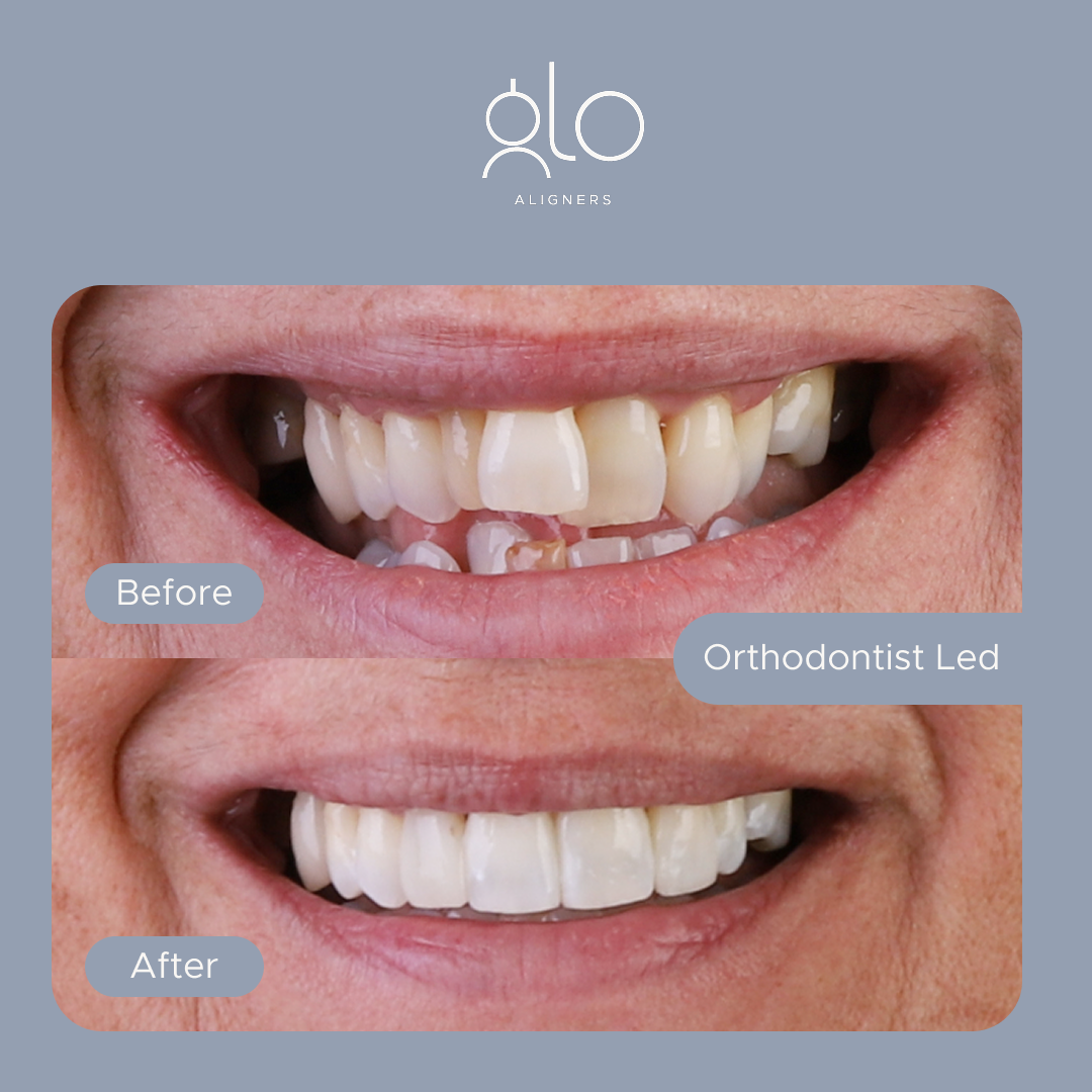 Glo Aligners before-and-after example 5