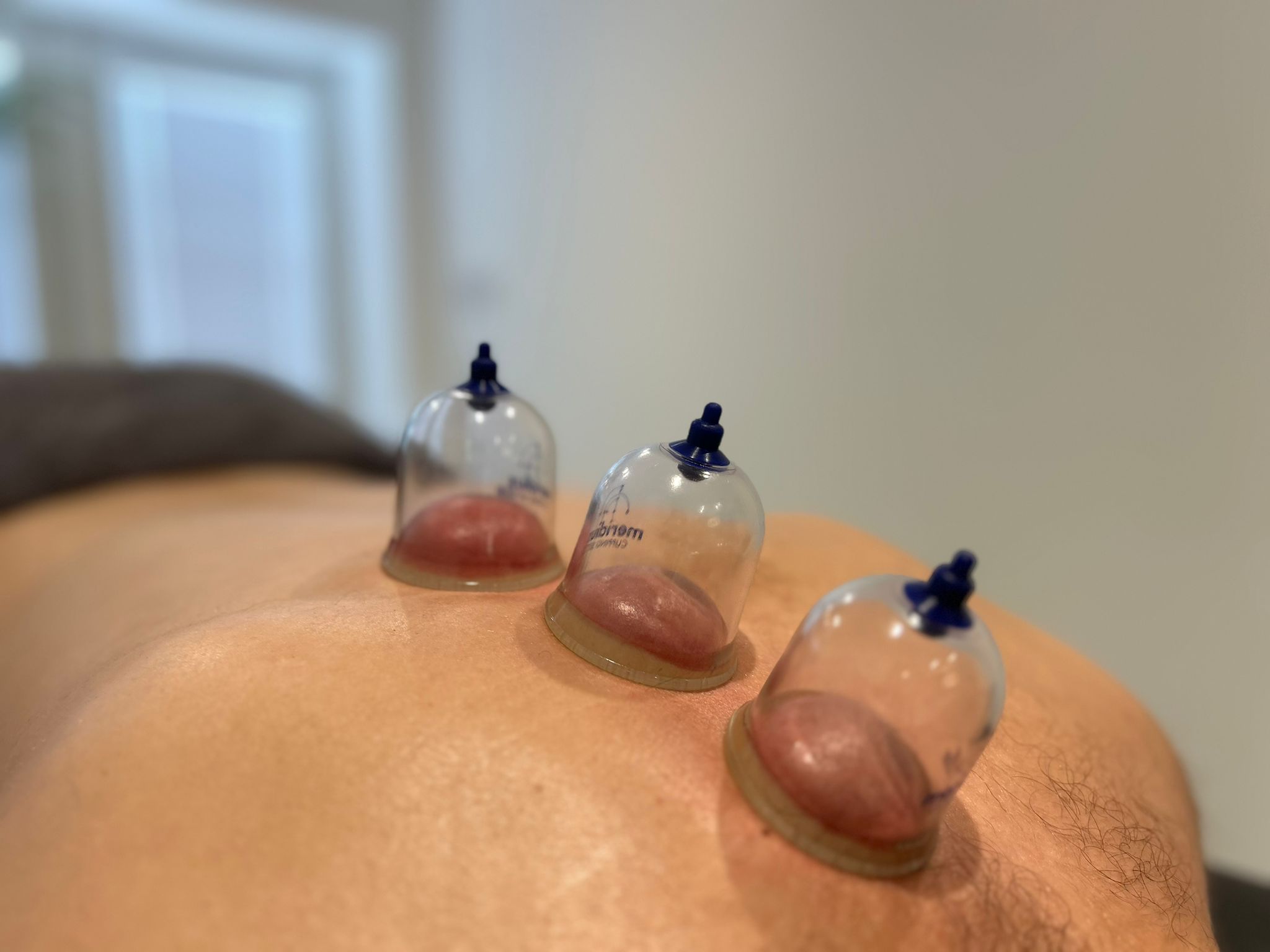 A method using suction cups on the skin to improve circulation, ease muscle tightness, and promote healing.