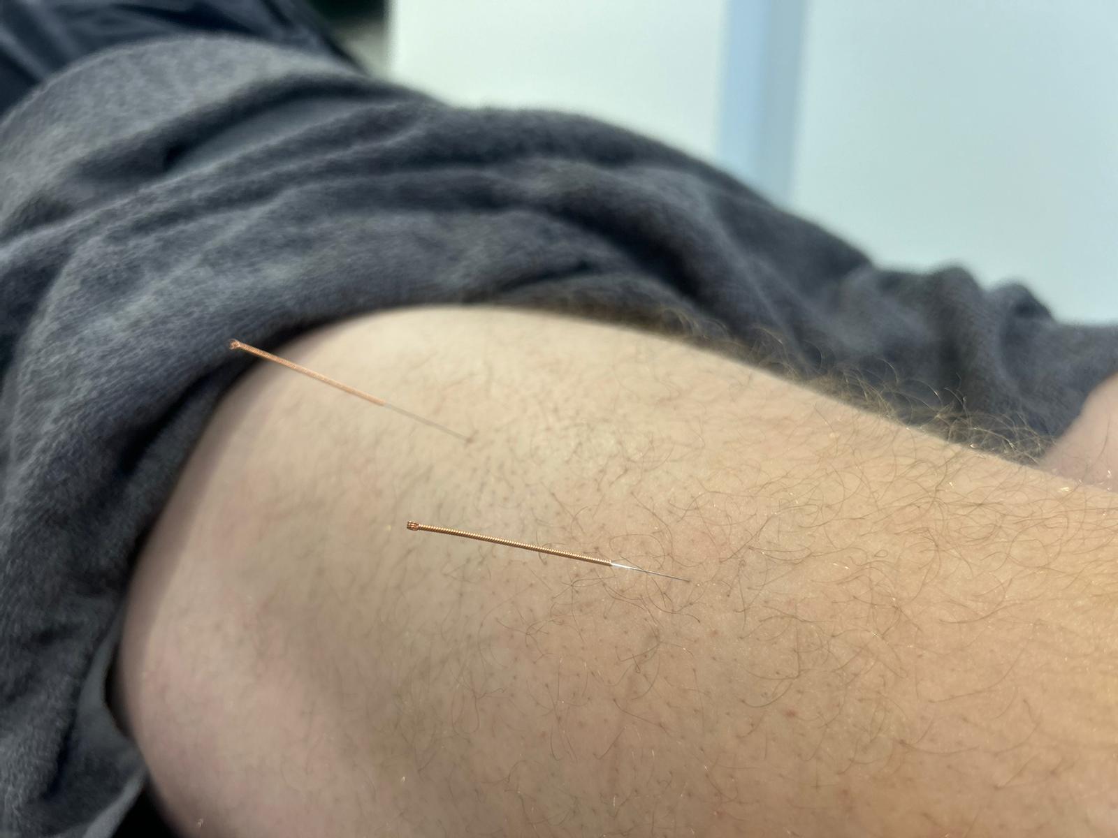 A targeted technique backed by sports scientists that's used to relieve pain, release muscle tension, and restore function.