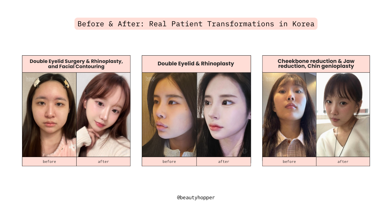 Plastic surgery in Korea before and after results