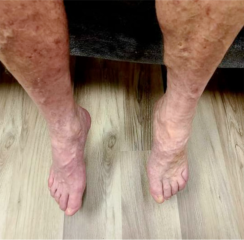 Leg and skin tissue regeneration therapy in Oro Valley, AZ