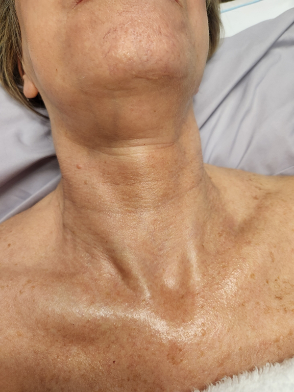 Laser Skin Rejuvenation Treatment - After Picture by Healthy Naturally You