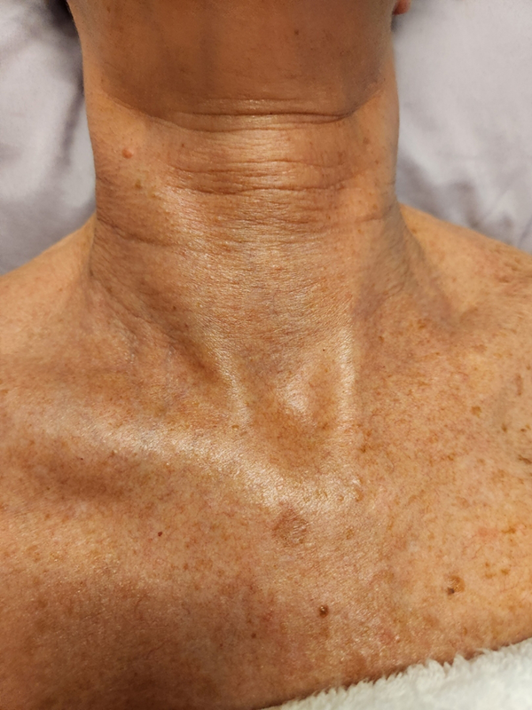 Laser Skin Rejuvenation Treatment - Before Picture by Healthy Naturally You