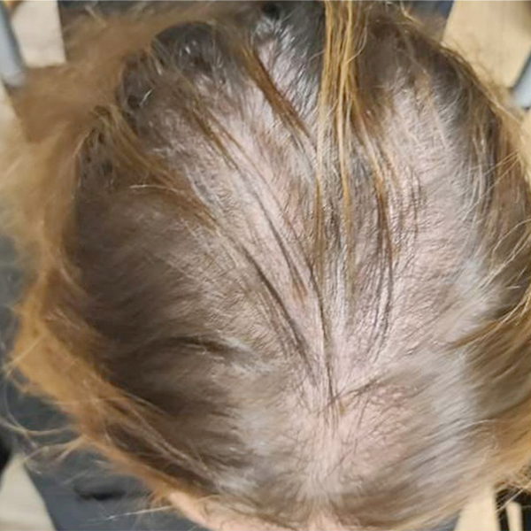 Hair Loss Restoration - Before Picture by Healthy Naturally You