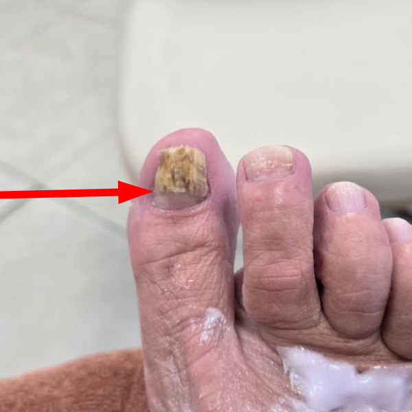 Toenail fungus elimination and grow-out by Healthy Naturally You